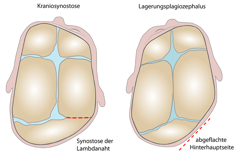 Differentialdiagnose lagerungsplagiozephalus kraniosynostose
