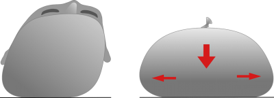 kopfform baby wie entsteht ein plagiocephalus