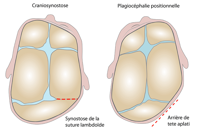 diagnostic différentiel plagiocéphalie positionnelle craniosynostose positionnelle
