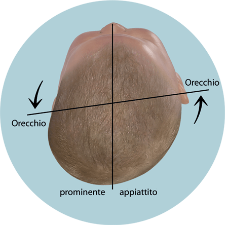 Valutare la forma della testa del bambino Asse auricolare spostato in caso di plagiocefalia