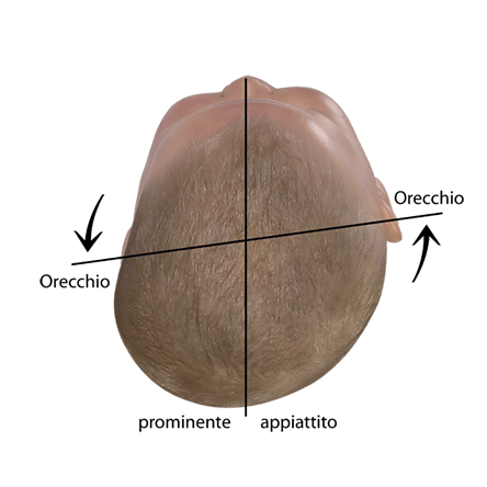 Valutare la forma della testa del bambino Asse auricolare spostato in caso di plagiocefalia