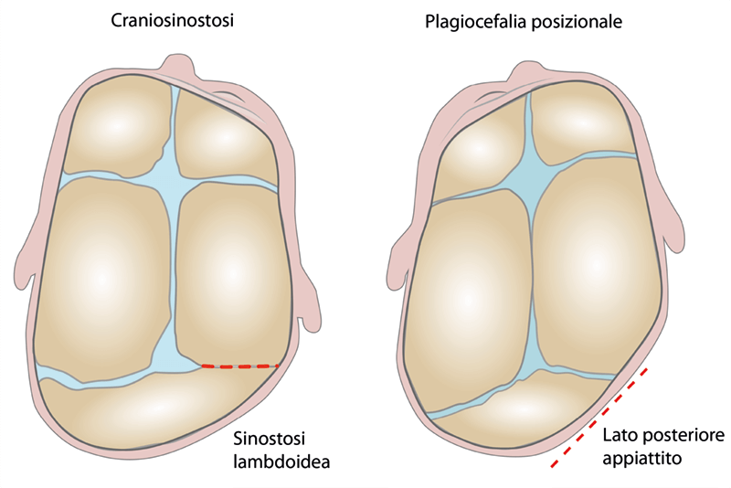 Diagnosi differenziale plagiocefalia posizionale craniosinostosi