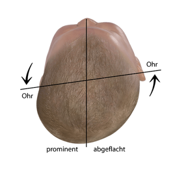 Baby Kopfform beurteilen verschobene Ohrachse bei Plagiocephalus