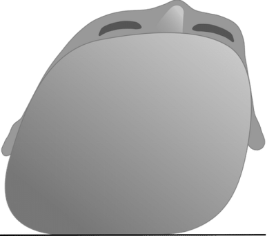 Baby Kopfform beurteilen verschobene Ohrachse bei Plagiocephalus