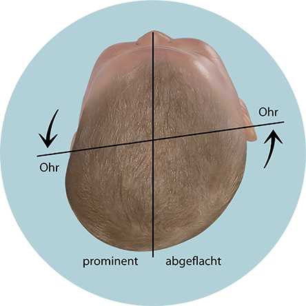 Baby Kopfform beurteilen verschobene Ohrachse bei Plagiocephalus
