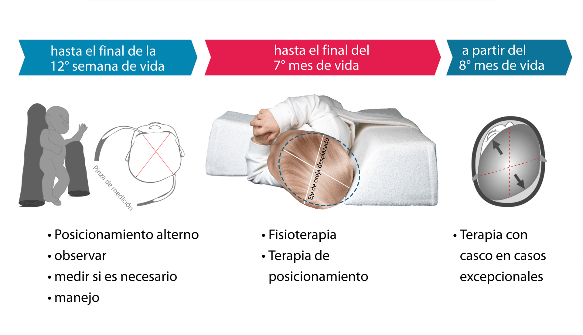 Intervención apropiada según estadio en plagiocefalia