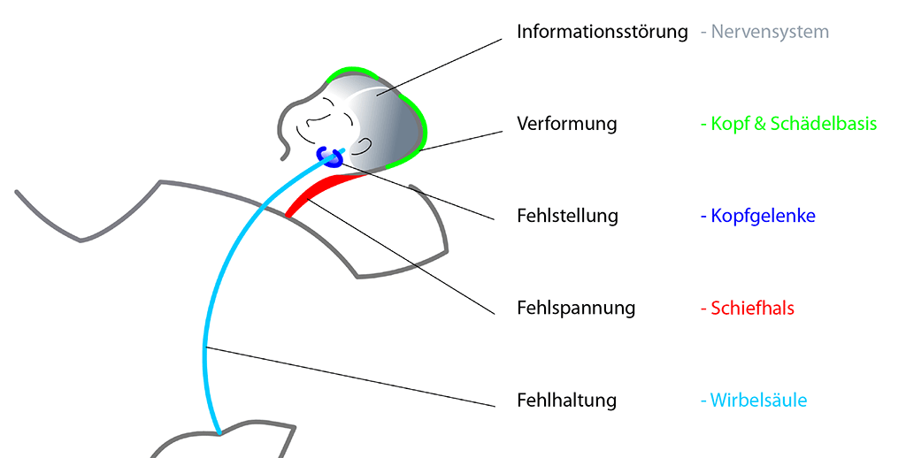 Symptomenkomplex der haltungsasymmetrie im saeuglingsalter