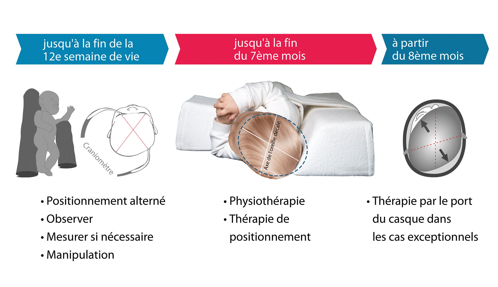 Intervention stage approprié plagiocephalie
