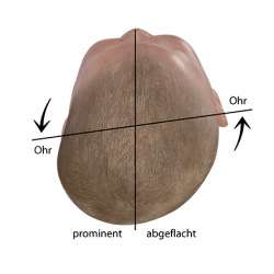 Baby Kopfform beurteilen verschobene Ohrachse bei Plagiocephalus