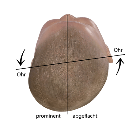 Baby Kopfform beurteilen verschobene Ohrachse bei Plagiocephalus