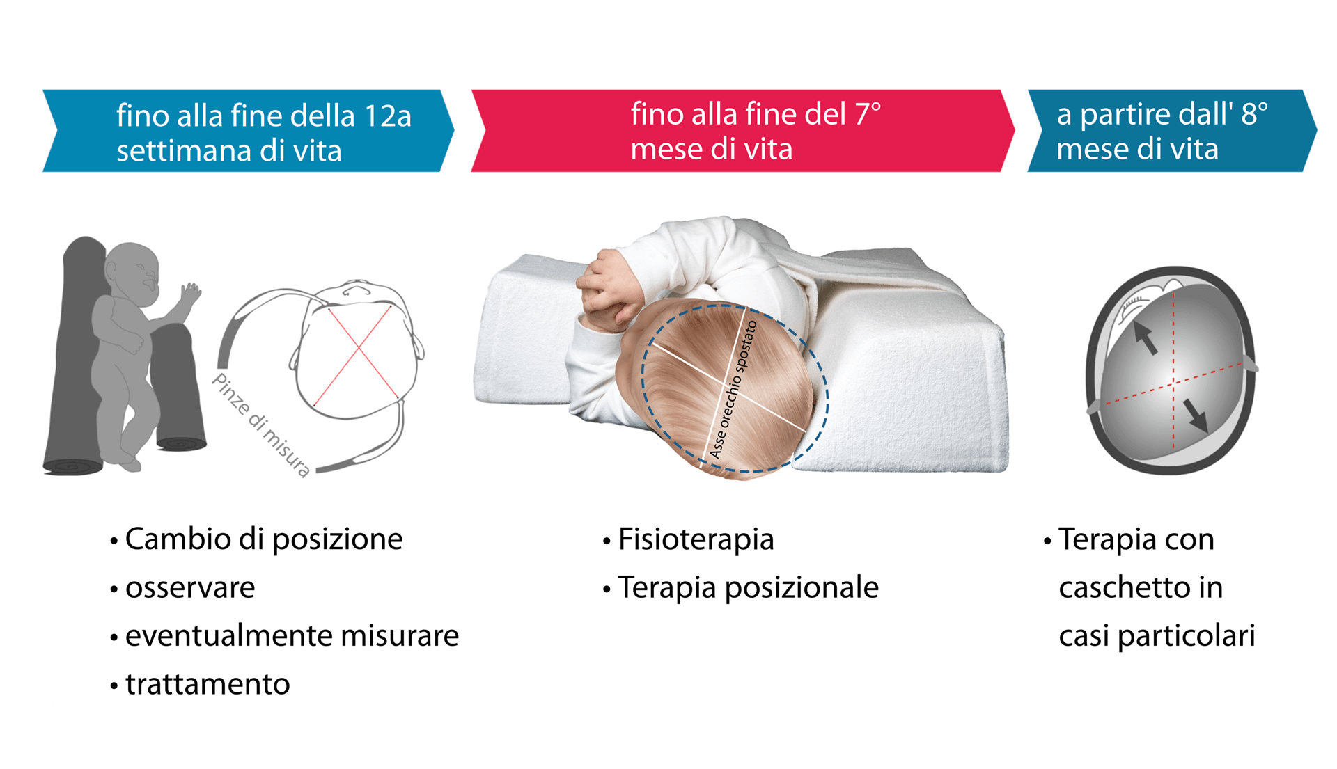 Intervento adeguato allo stadio Plagiocefalia