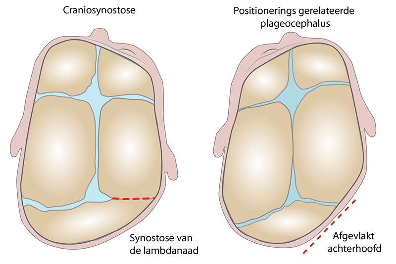 Differentiaaldiagnose positieve plagiocephalus craniosynostose