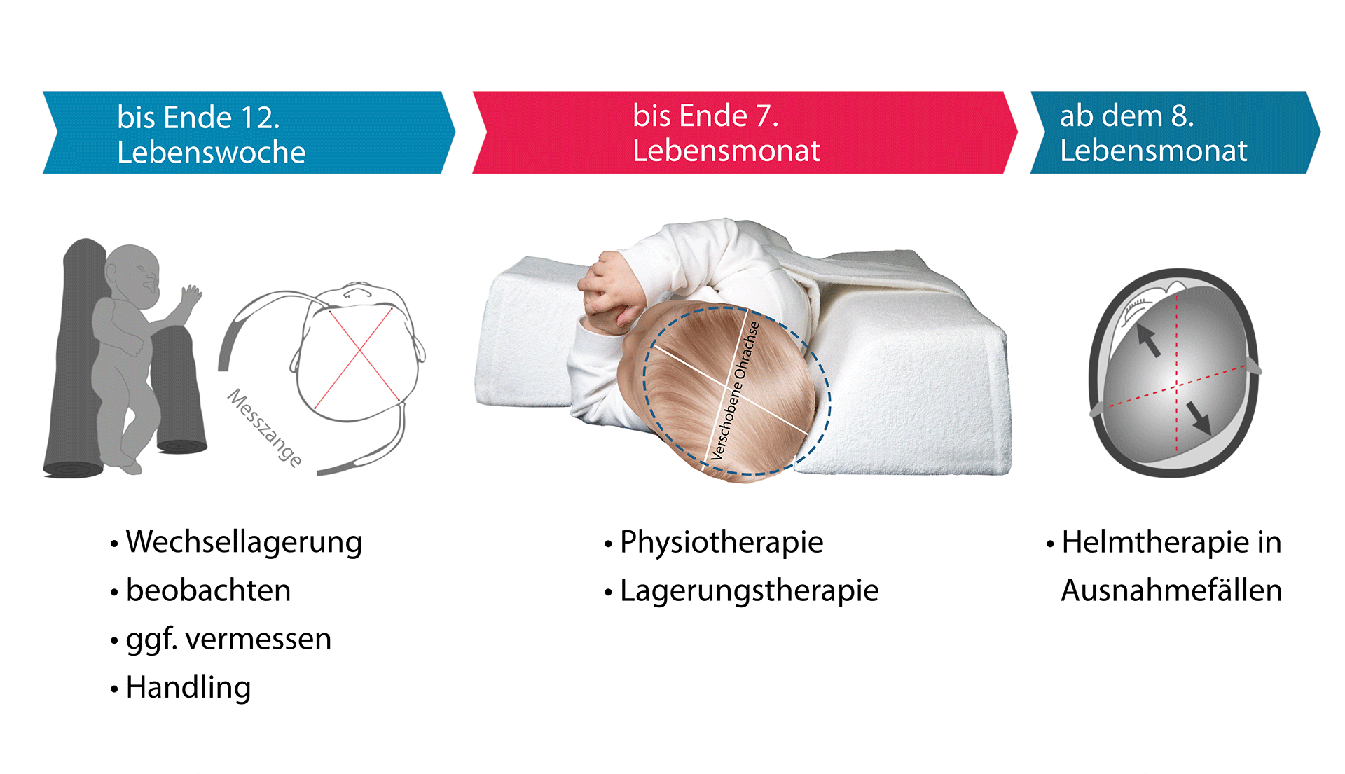 Stadiengerechte Intervention Plagiocephalus