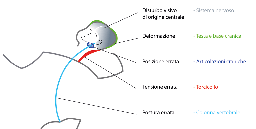 Complesso di sintomi dell'asimmetria posturale nell'infanzia