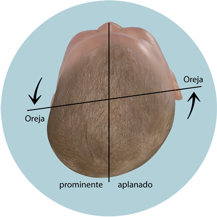 Evaluar la forma de la cabeza del bebé eje de oreja desplazado en plagiocefalia