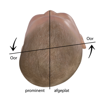Baby hoofd vorm beoordeling verplaatste orbitale as in plagiocephalus
