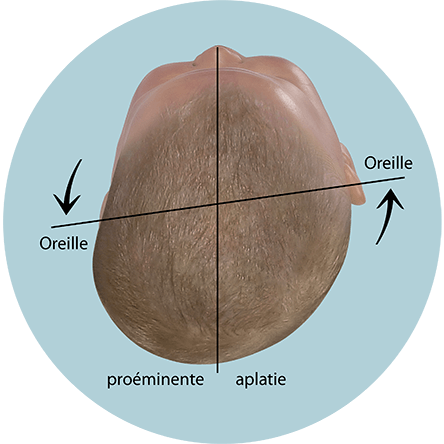 Bébé évaluer forme de tête axe des oreilles décalé plagiocéphalie