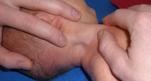 Musculus Sternoclaidomastoideus baby