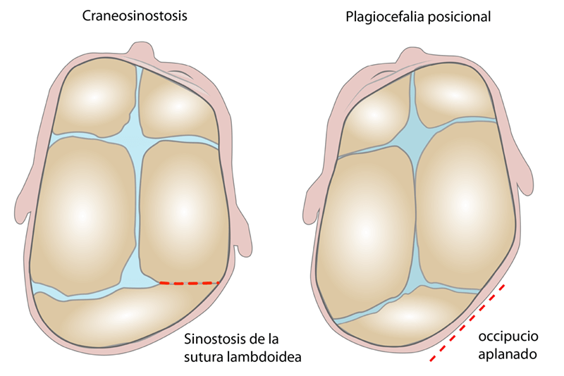 Diagnóstico diferencial plagiocefalia posicional y craneosinostosis