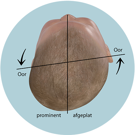 Baby hoofd vorm beoordeling verplaatste orbitale as in plagiocephalus