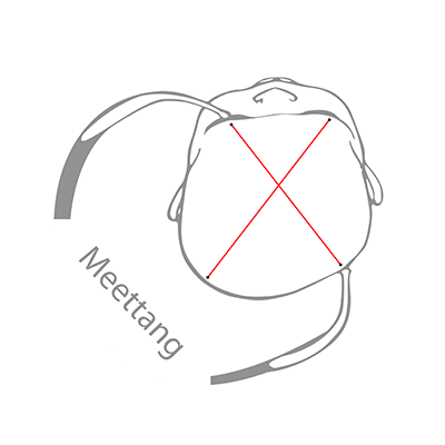 Messzange het meten van de vervorming van het hoofdje van de baby