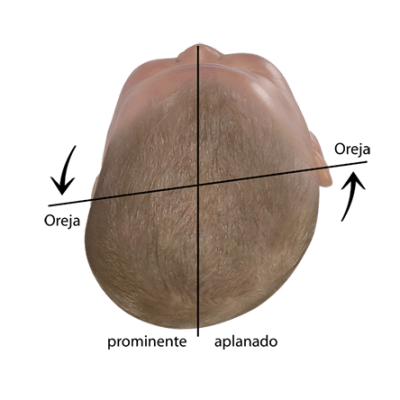 Evaluar la forma de la cabeza del bebé eje de oreja desplazado en plagiocefalia