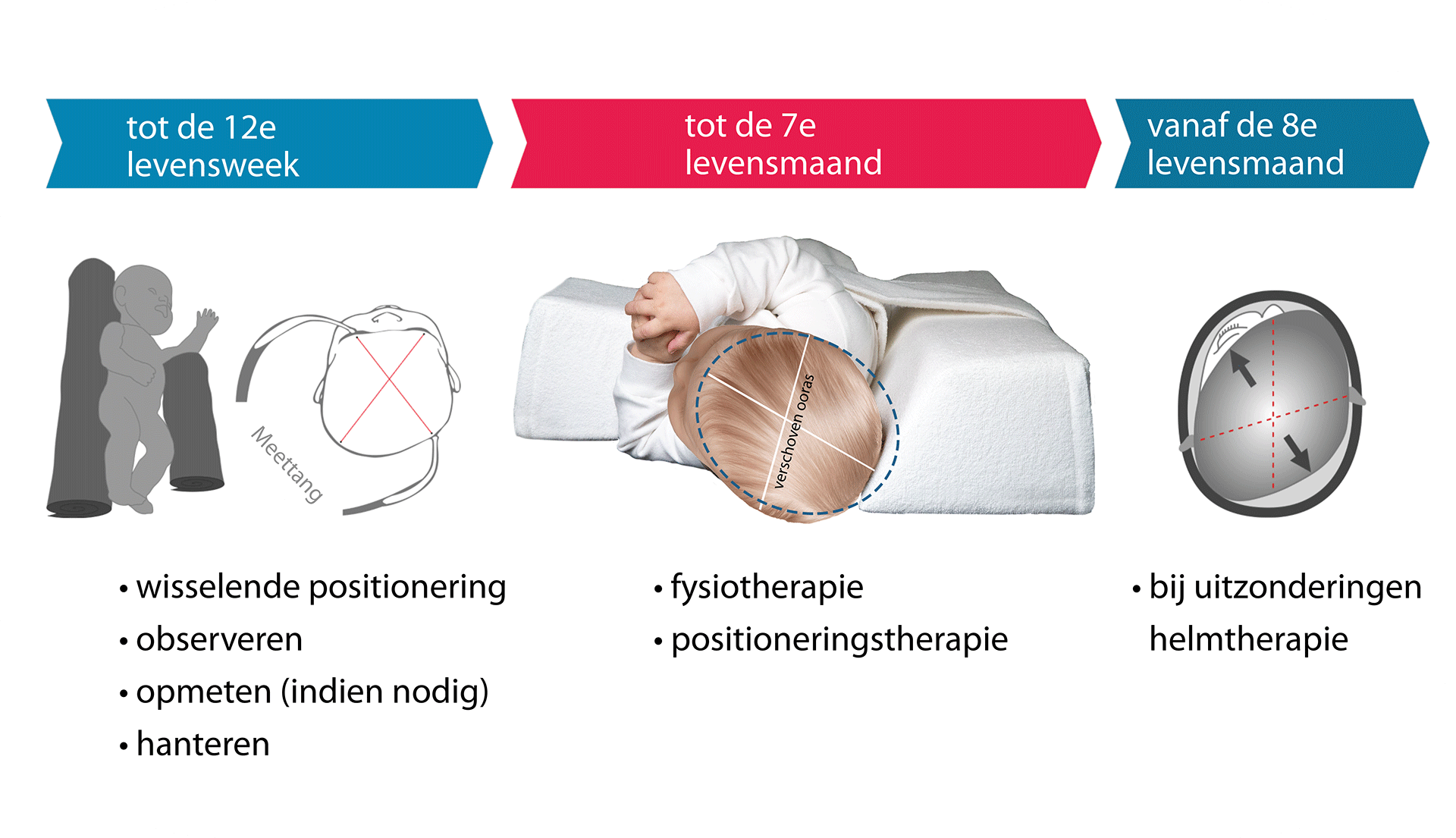 Geënsceneerde interventie plagiocefalie
