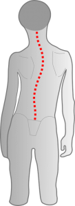 Kind mit skoliotischer Fehlhaltung