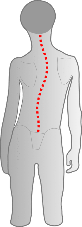 Kind mit skoliotischer Fehlhaltung