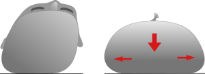  deformación posicional de la forma de la cabeza