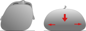  lagebedingte Deformation der Kopfform