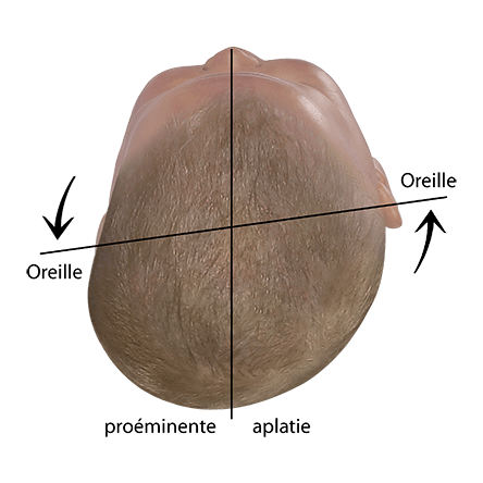 Évaluation de la forme de la tête de bébé déformée avec décalage de l'axe de l'oreille
