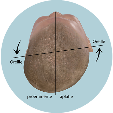 Évaluation de la forme de la tête chez les bébés - plagiocéphalie avec déplacement de l'axe de l'oreille