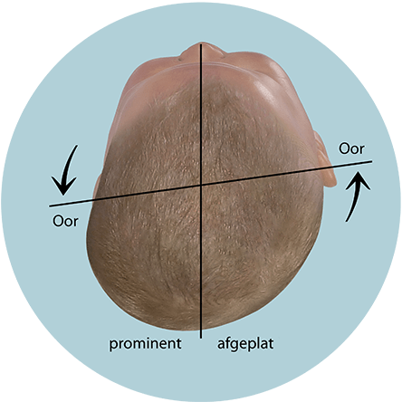 Beoordeling van de hoofdvorm van uw baby - plagiocefalie met een verschoven ooras