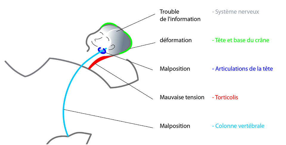 Asymétrie posturale bébé