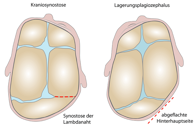 B7.2-de-Differentialdiagnose-lagerungsplagiozephalus-kraniosynostose-20210305 lagebedingter Plagiocephalus