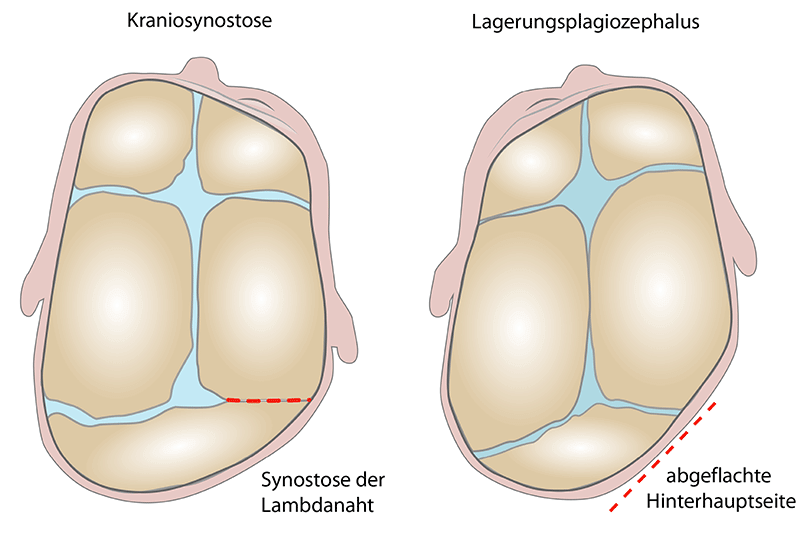 lagebedingter Plagiocephalus