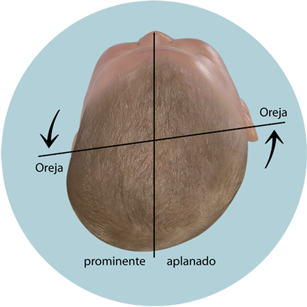 Evaluar la forma de la cabeza del bebé eje de oreja desplazado en plagiocefalia