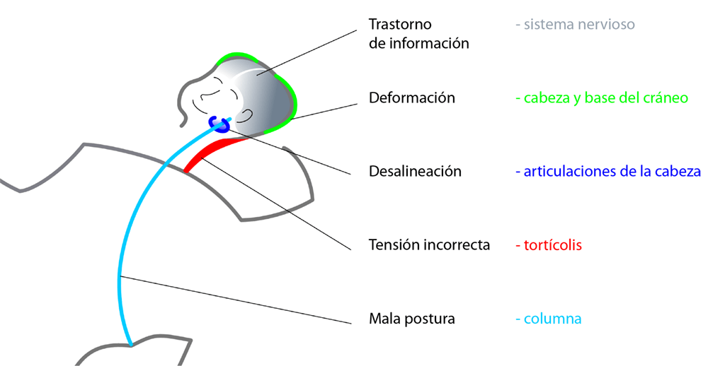 Conjunto de síntomas de posturas asimétricas en la infancia