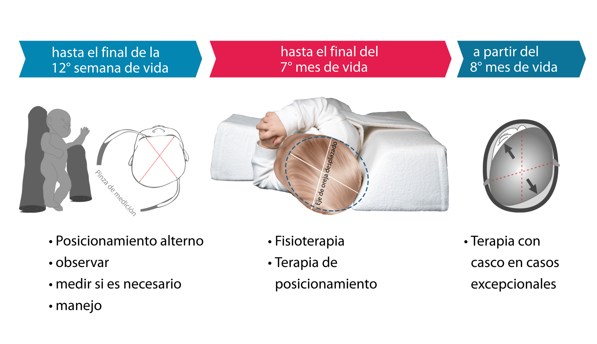 Intervención apropiada según estadio en plagiocefalia