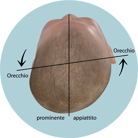 Valutazione della forma della testa nel bambino - Plagiocephalus con asse dell'orecchio spostato