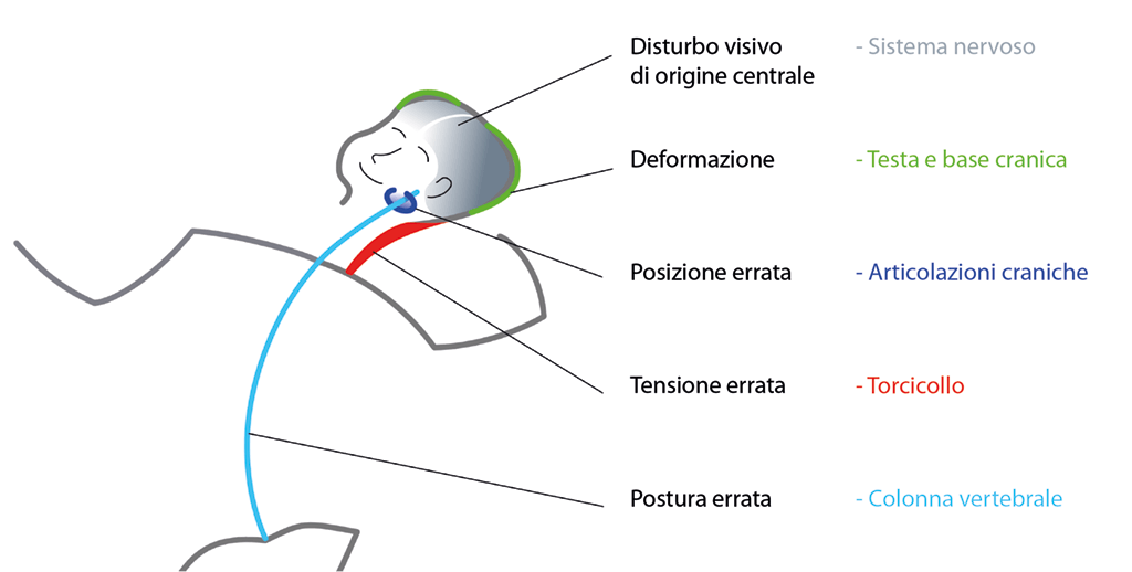 Asimmetria posturale del neonato