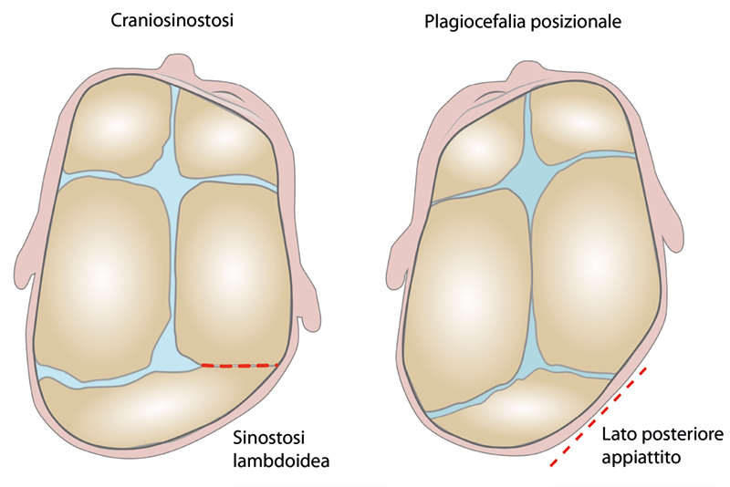 Plagiocefalia posizionale