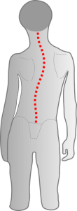 Kind mit Skoliotischer Fehlhaltung