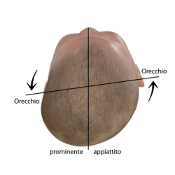 Valutare la forma della testa del bambino Asse auricolare spostato in caso di plagiocefalia