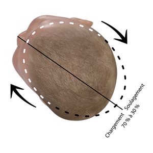 Position de correction tête du bébé plagiocéphalie