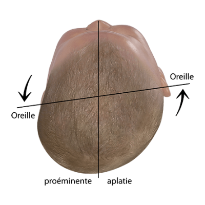 Bébé évaluer forme de tête axe des oreilles décalé plagiocéphalie