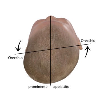 Valutare la forma della testa del bambino Asse auricolare spostato in caso di plagiocefalia
