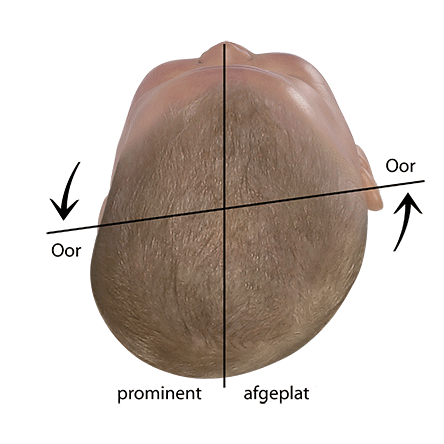 Baby Kopfform beurteilen verschobene Ohrachse bei Plagiocephalus
