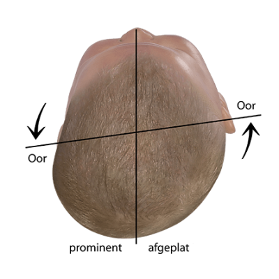 Baby hoofd vorm beoordeling verplaatste orbitale as in plagiocephalus